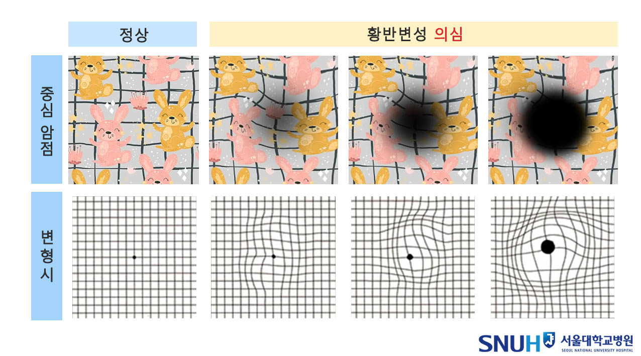 시력 왜곡